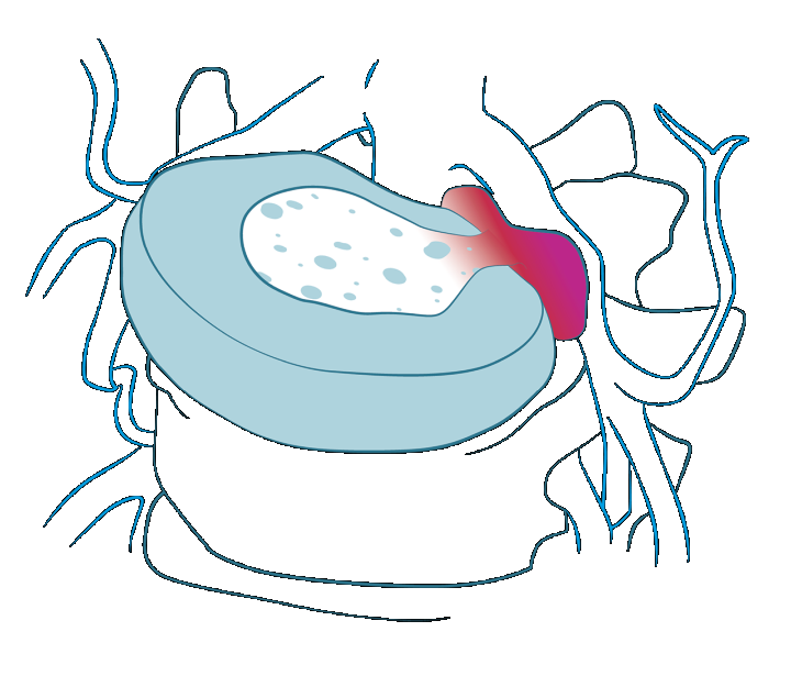 Dyskopatia, wypadający dysk, ból kręgosłupa, ucisk na nerw, leczenie, objawy, przyczyny