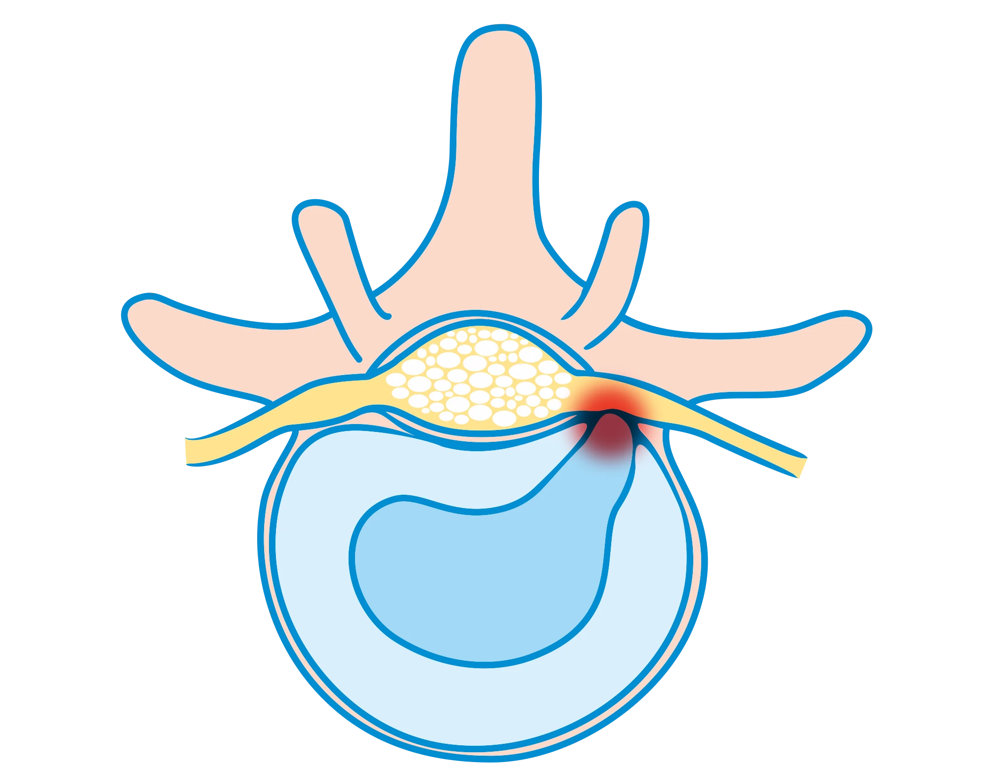 Bandscheibenextrusion, Nucleus pulposus, Bandscheibenschäden