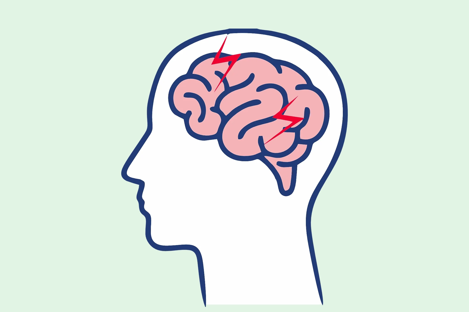 Myoklonus, Epilepsie, Gehirntumor