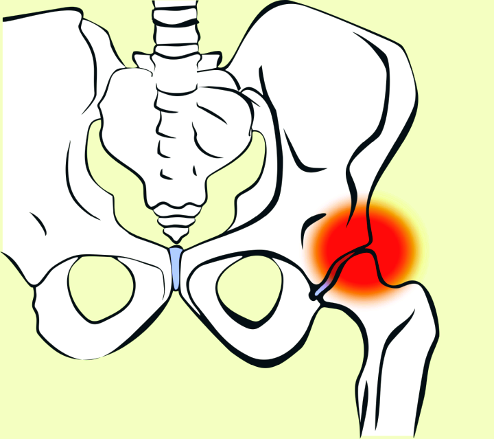 Hip pain, arthritis, hip joint diseases