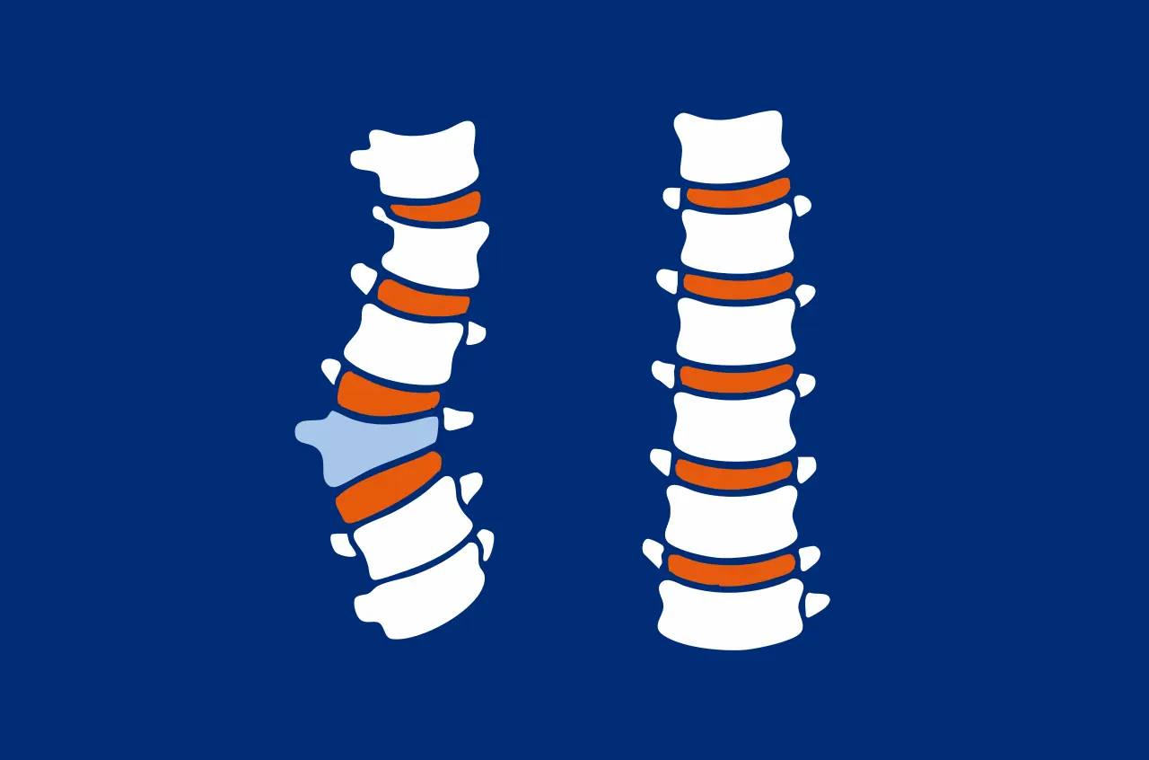 Hemivertebra, hemivertebra, orthopaedics, health
