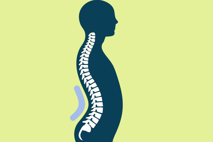 Lumbar lordosis, back pain, lower back, backache