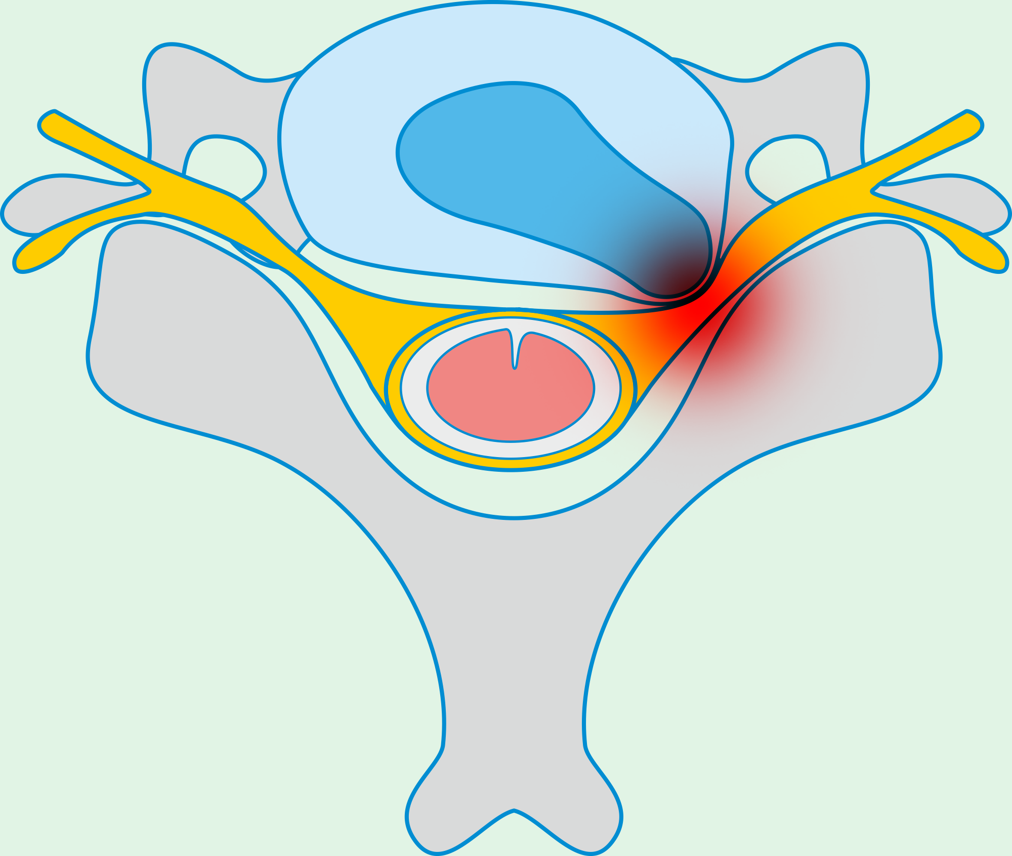 Protrusion of intervertebral disc, treatment of disc protrusion, back pain