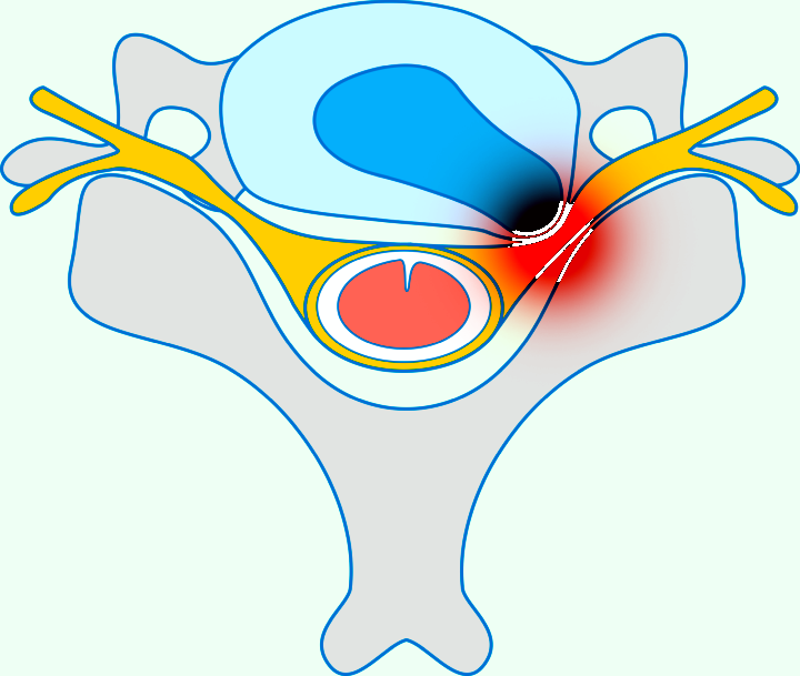 Protrusion of intervertebral disc, treatment of disc protrusion, back pain