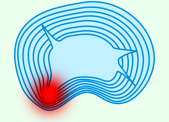 Intervertebral disc herniation, discopathy, spinal degeneration