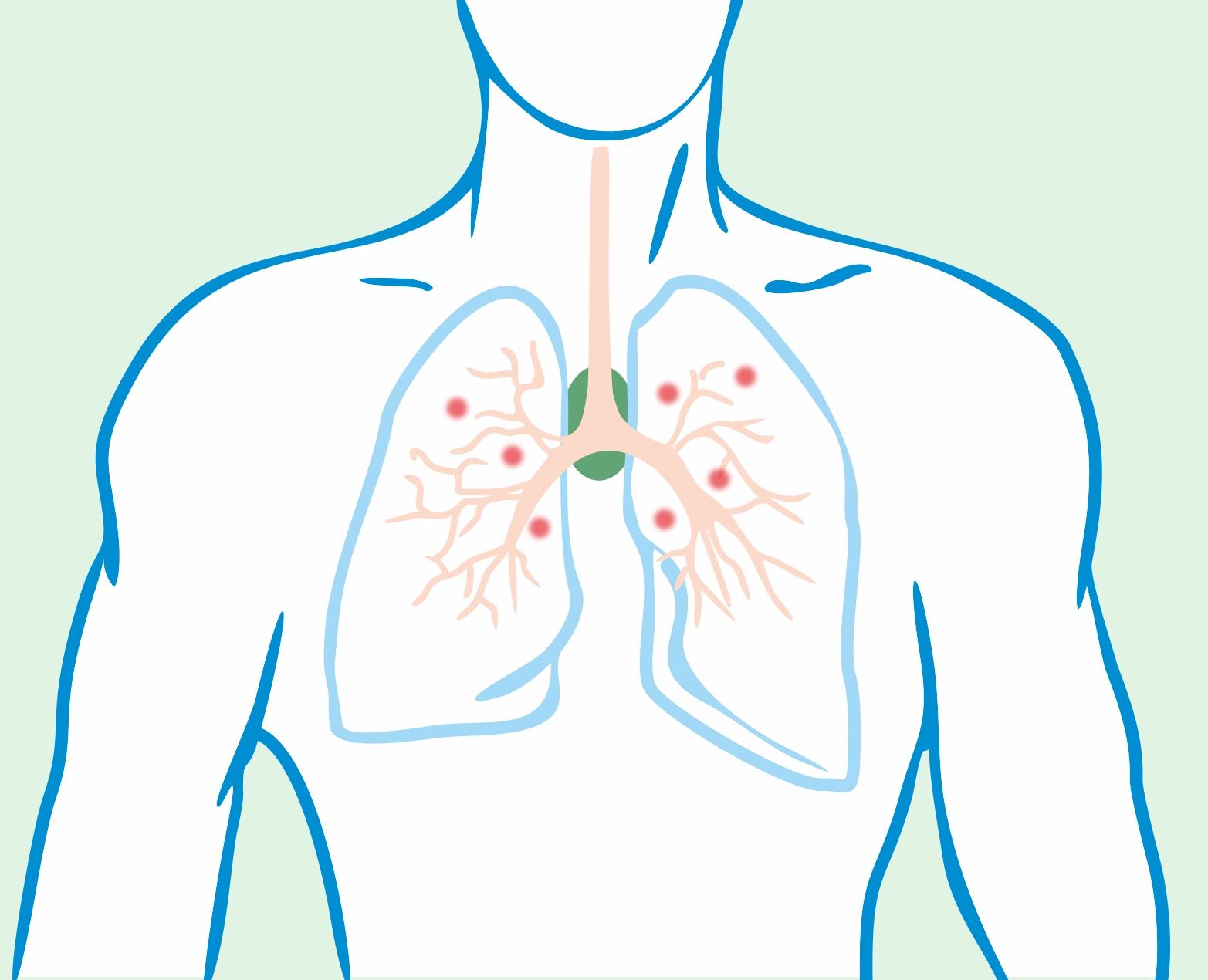 Sarcoidosis, pulmonology, lung diseases