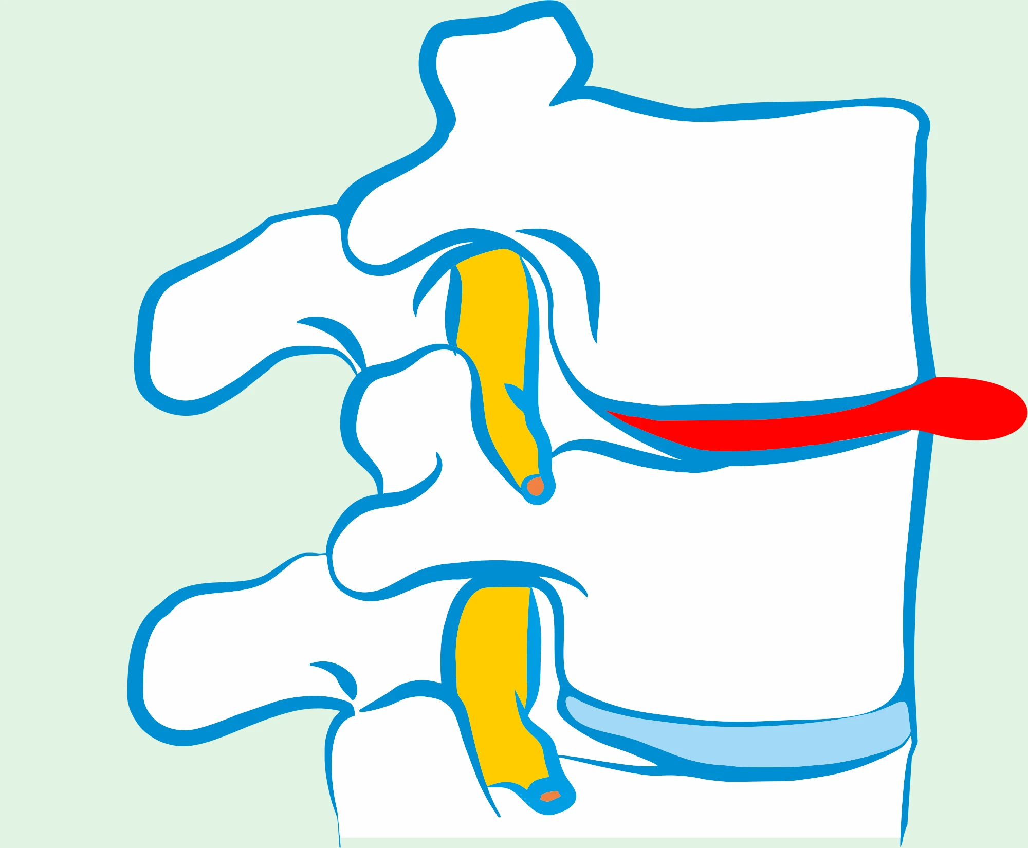 Disk sequestration, stages of discopathy, severe back pain