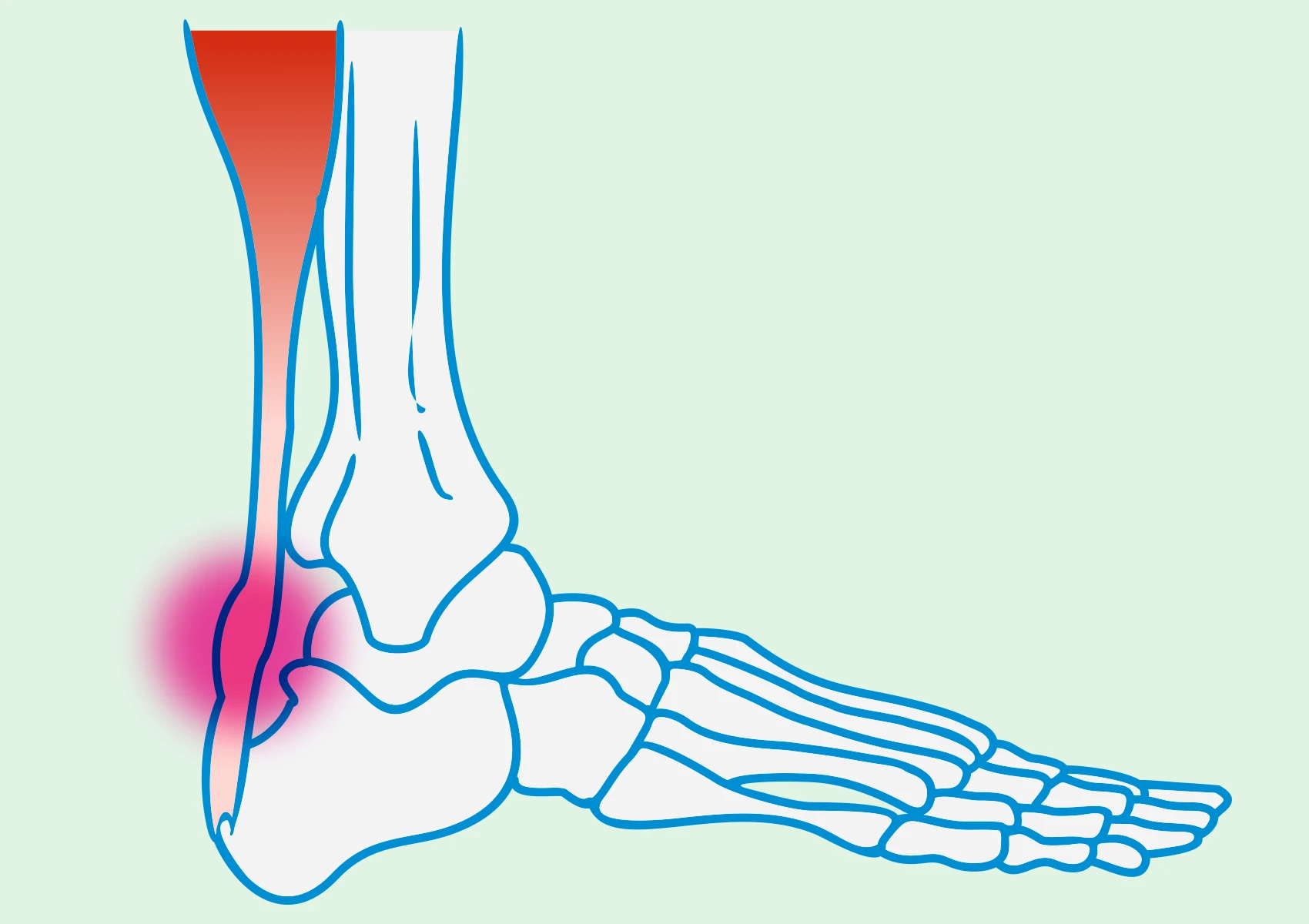 Tendinopathy, tendon degeneration, leg pain