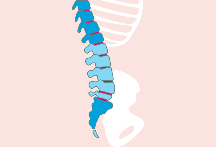 Reduced lumbar lordosis, spine mattress, back pain