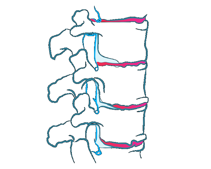 Zwyrodnienie kręgosłupa, osteofity, osteoartroza, choroba zwyrodnieniowa kręgosłupa