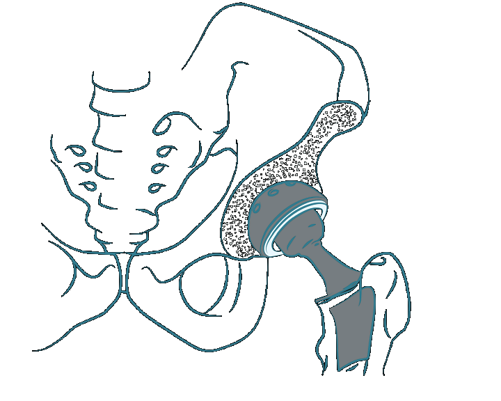 Endoproteza biodra, schemat endoprotezy biodra, staw biodrowy, endoproteza stawu biodrowego, sztuczne biodro